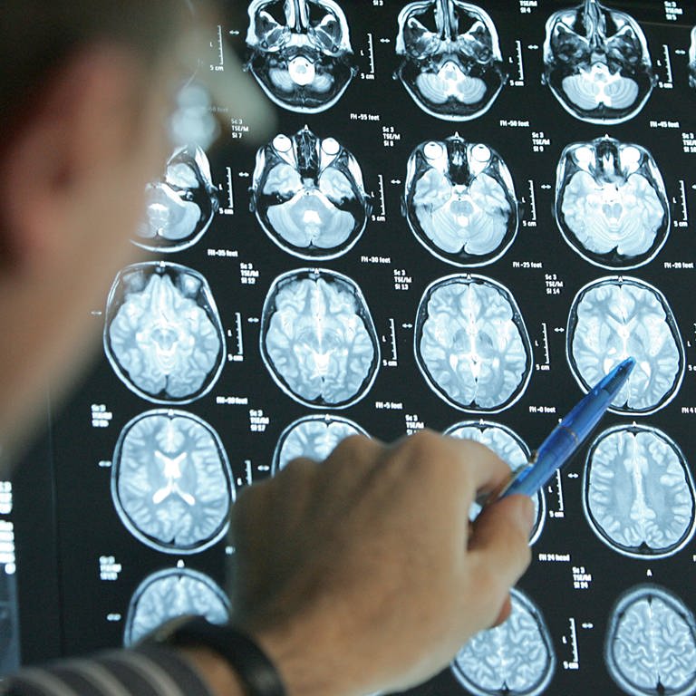Ein Arzt deutet mit einem Stift auf die MRT-Bilder, die von einem Gehirn aufgenommen wurden.